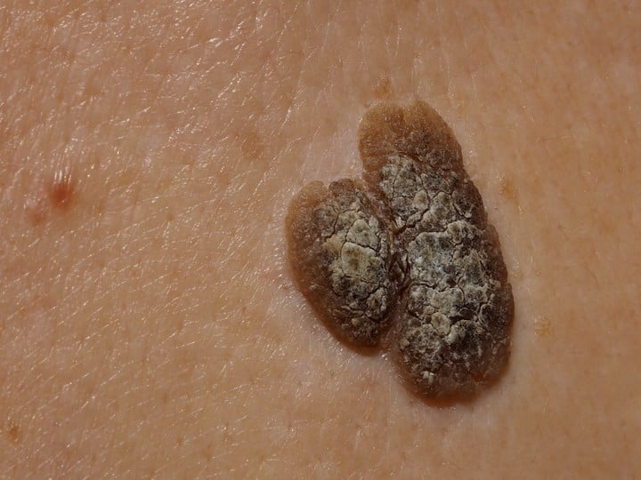 La queratosis seborreica aparece con la edad y es benigna. Foto Shutterstock.