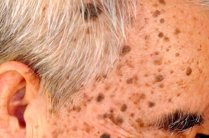 Hay personas que pueden tener miles de queratosis seborreicas. Foto Shutterstock.