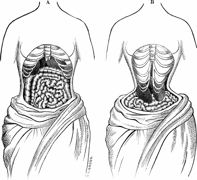 Una ilustración de lo que los médicos victorianos creían que era la consecuencia de los corsés ajustados. 