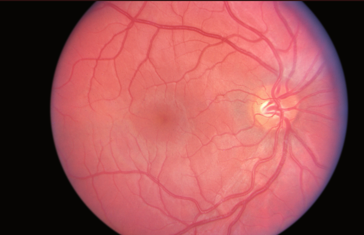 Mirar directamente al sol puede causar retinopatía solar o daño a la fóvea central de la retina, que se ve aquí justo a la izquierda del centro.