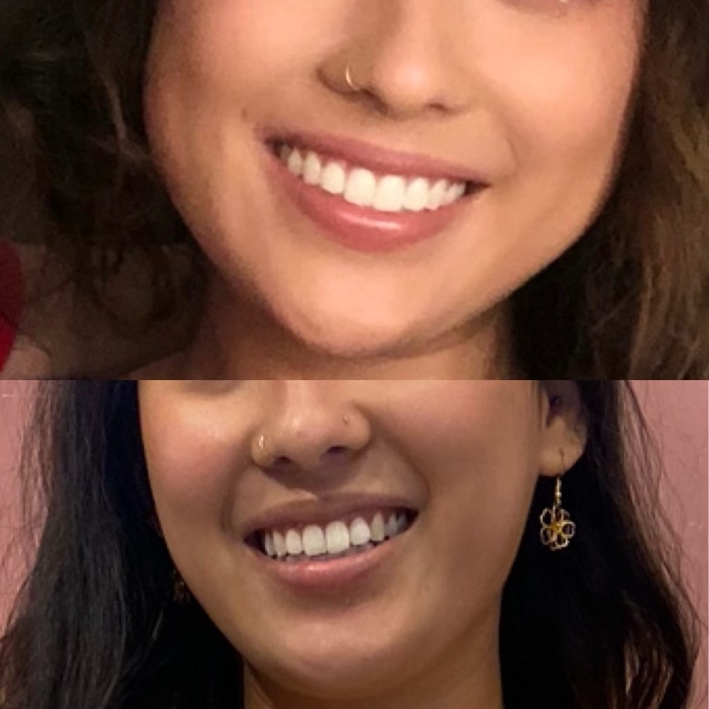 Foto de antes y después del botox masetero.