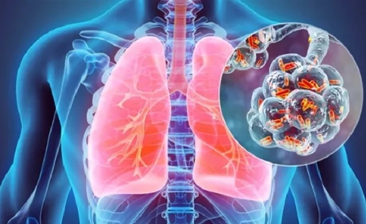 La neumonía es una inflamación de los pulmones que suele generarse por un agente patógeno que ingresa por las vías respiratorias.