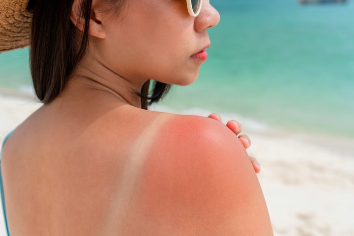 La exposición al sol, luego de muchos años, puede generar manchitas blancas. Foto Shutterstock.