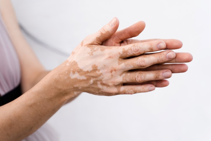 El vitiligo es una enfermedad autoinmune que genera una despigmentación en la piel. Foto Shutterstock.