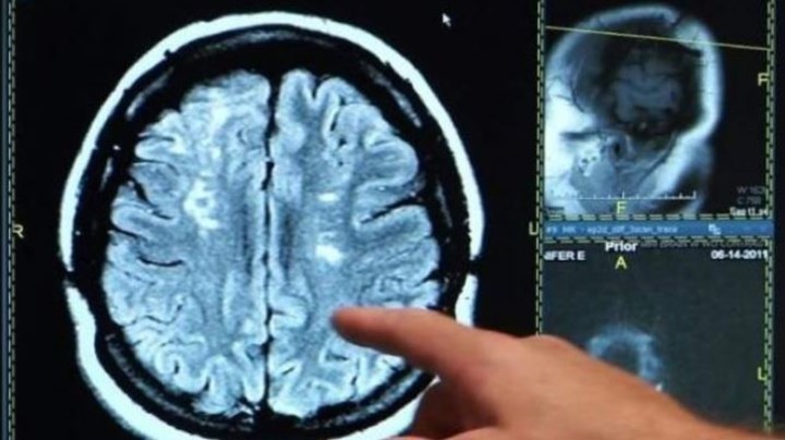 Permite examinar la anatomía del cerebro y evaluar el daño de lesiones y de enfermedades como el Alzheimer.