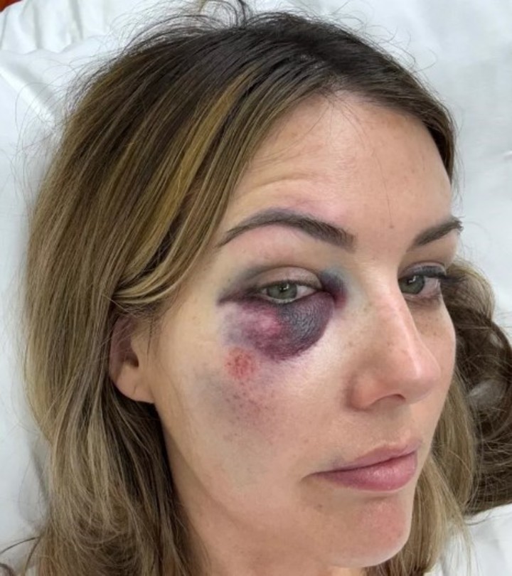 Emily dijo que se desplomó y se golpeó la cabeza, lo que le provocó un ojo morado y un hematoma en el brazo.