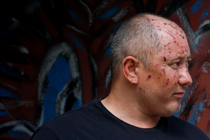 Uno de los heridos en los ataques. Foto: Reuters