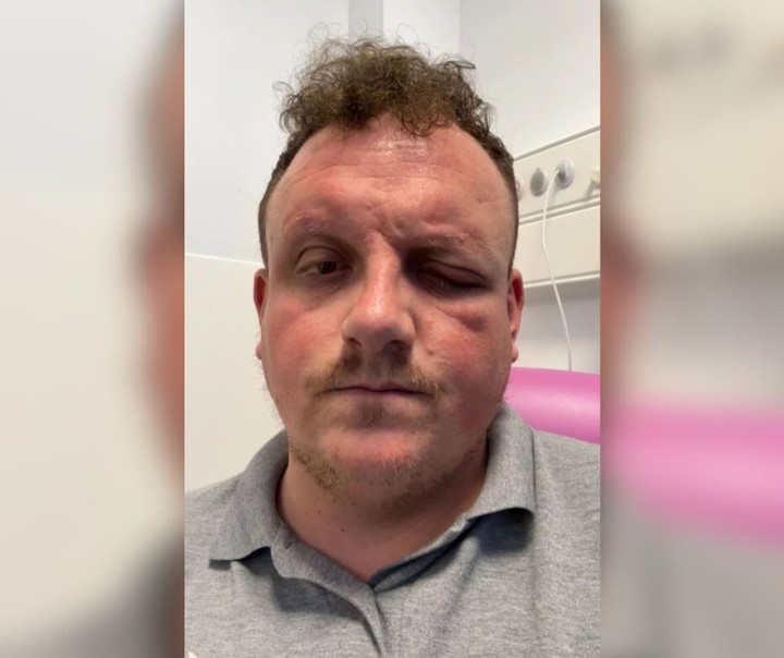 El hombre compartió una foto de su rostro, al momento de sufrir la afección. Foto: Jordan/Via Kennedy News and Media.