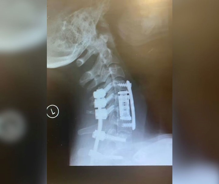 Una radiografía del cuello de la joven, luego de la operación. Foto: Becca.