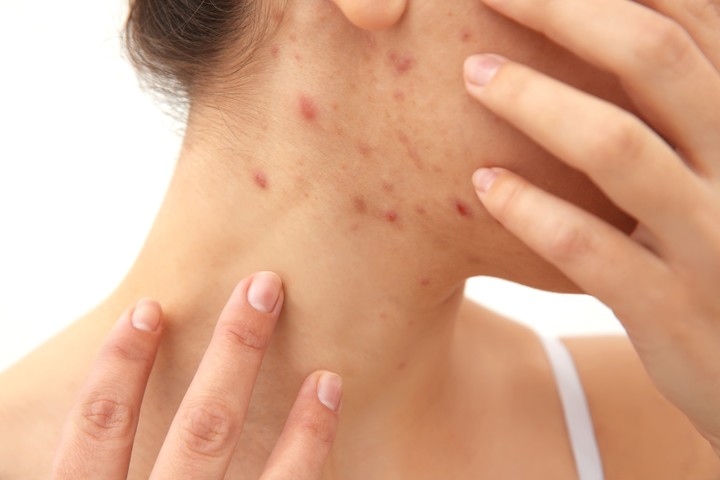 Los pliegues oscuros de la piel o la pérdida de cabello junto a la alteración de la piel por acné son síntomas de hígado graso./ Foto: Shutterstock.