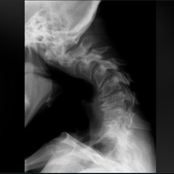 En un hospital atendieron un raro caso de síndrome de cabeza caída 