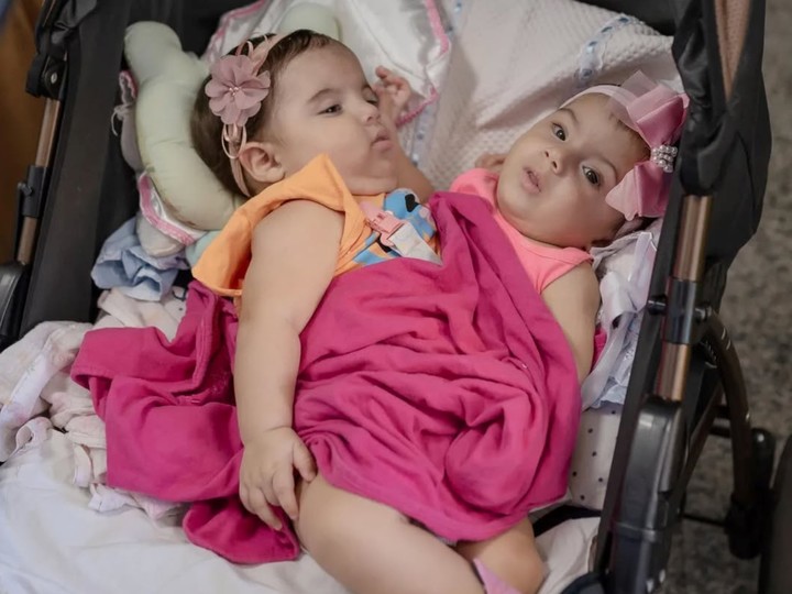 Las gemelas siamesas fueron separadas a través de una compleja cirugía. (Foto: Instagram @kirazaruna)