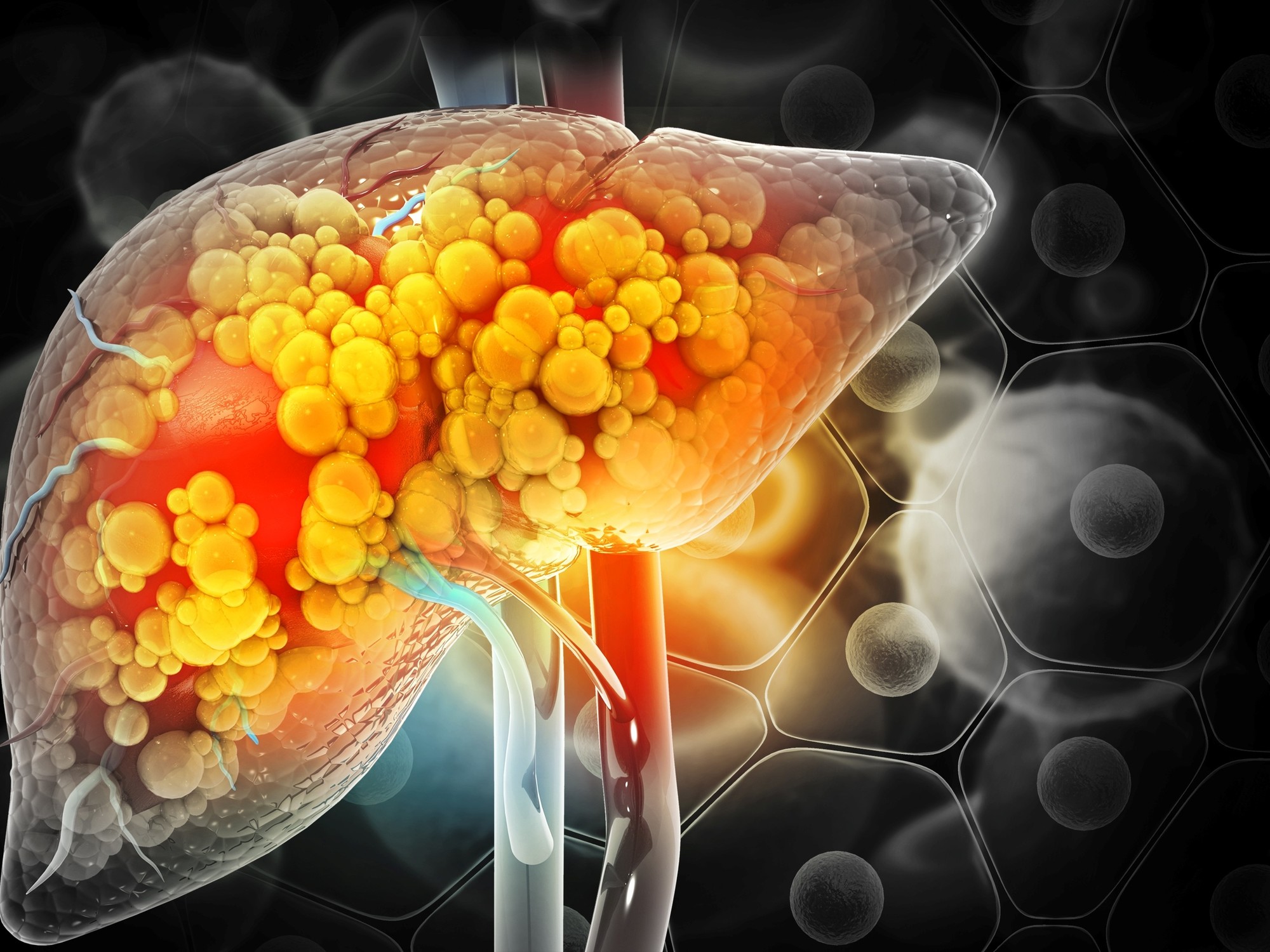 Hígado graso. Existen dos tipos de hígado graso. El no alcohólico (HGNA) y el alcohólico (HGA)./ Imagen: Shutterstock.