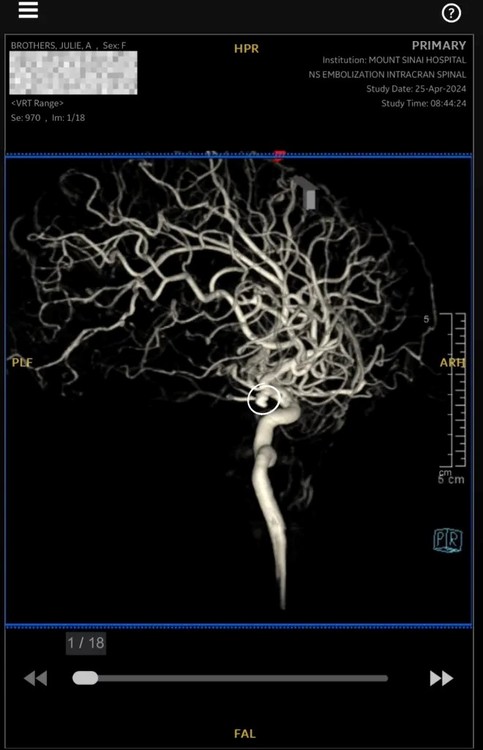 Julie Brothers compartió la tomografía que le hicieron cuando finalmente descubrieron que sufría un aneurisma.