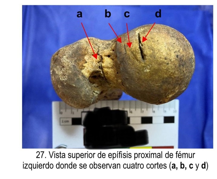 Cortes en el hueso de la rodilla, indicio de que quisieron descuartizar el cuerpo.
