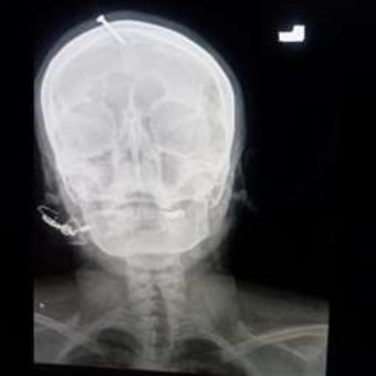Para que "tuviera un varón", un curandero le clavó un clavo en la cabeza a una embarazada 