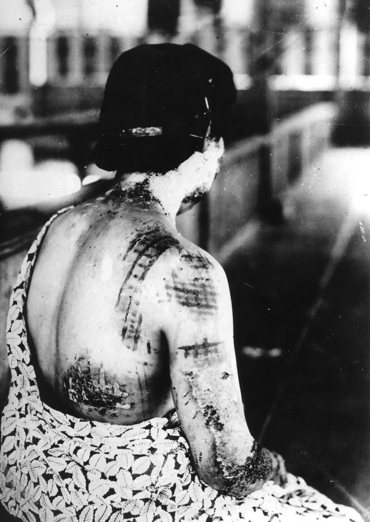 El calor de la bomba quemó un patrón de kimono en la piel de esta mujer. Foto Gonichi Kimura, cortesía del Museo Memorial de la Paz de Hiroshima.